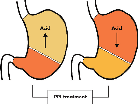 PPI treatment for acid reflux - adderall side effects